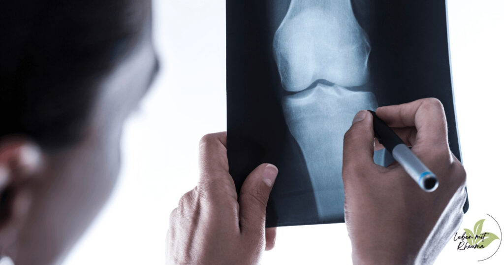 Coxarthrose Ein Arzt der ein Rötngenbild einer Coxarthrose anschaut